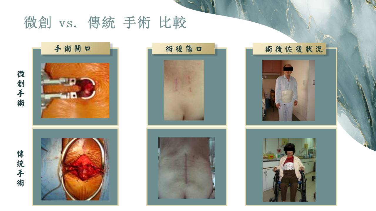 傳統手術示意圖